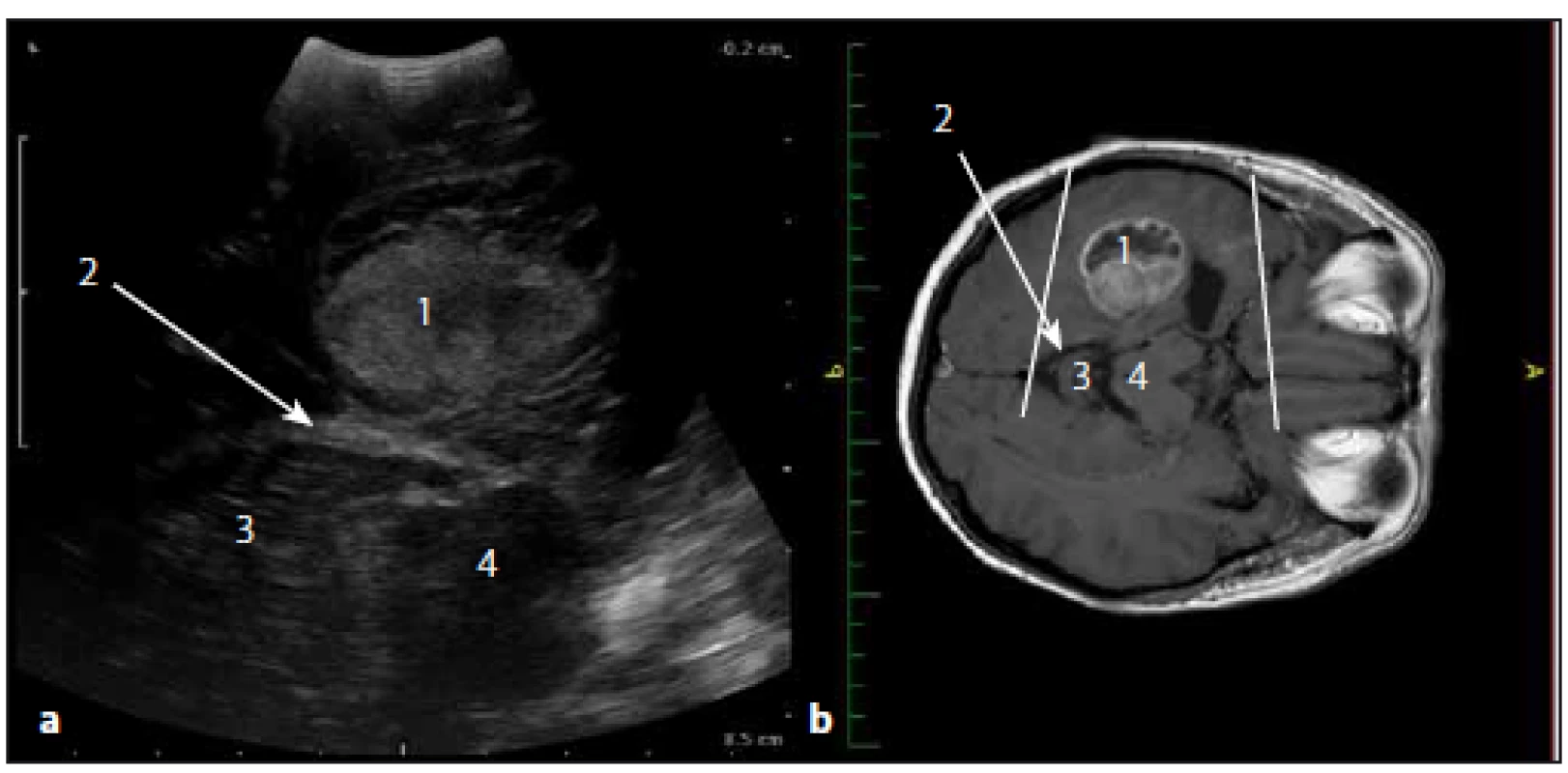 Sonografický obraz a odpovídající upravený MR T1W obraz glioblastomu levého temporálního laloku.
Fig. 8. Ultrasound image and corresponding adjusted MRI T1W image of the temporal lobe glioblastoma.