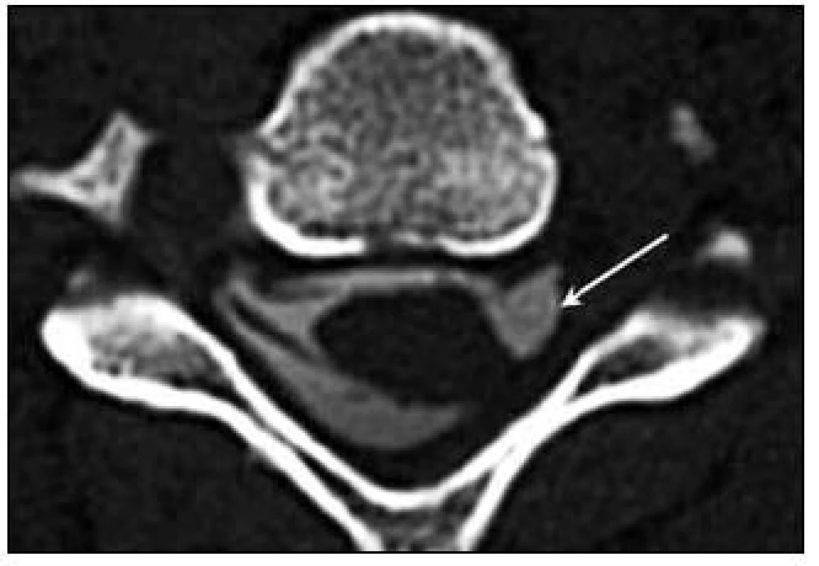 CT-PMG – šipka ukazuje na chybějící kořeny C6 a laterální deviaci durálního vaku vpravo, vlevo zřetelně viditelný přední i zadní kořen.