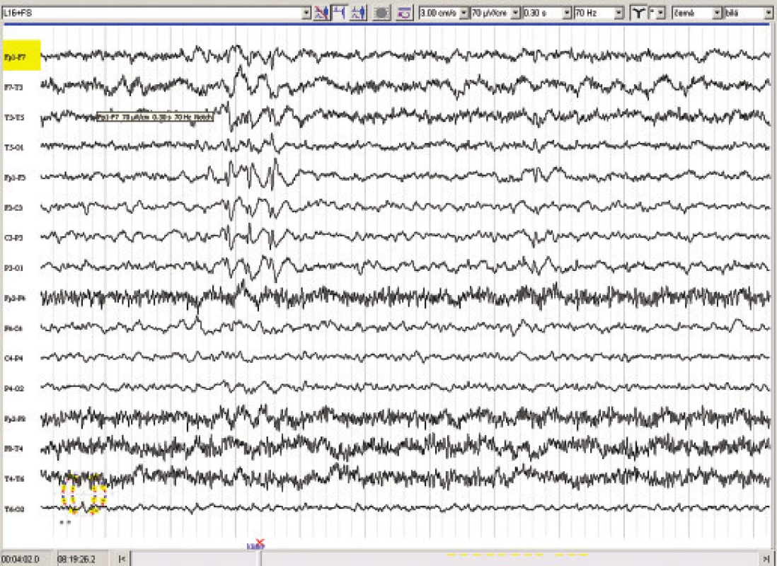 EEG před ozářením Leksellovým gamma nožem.
