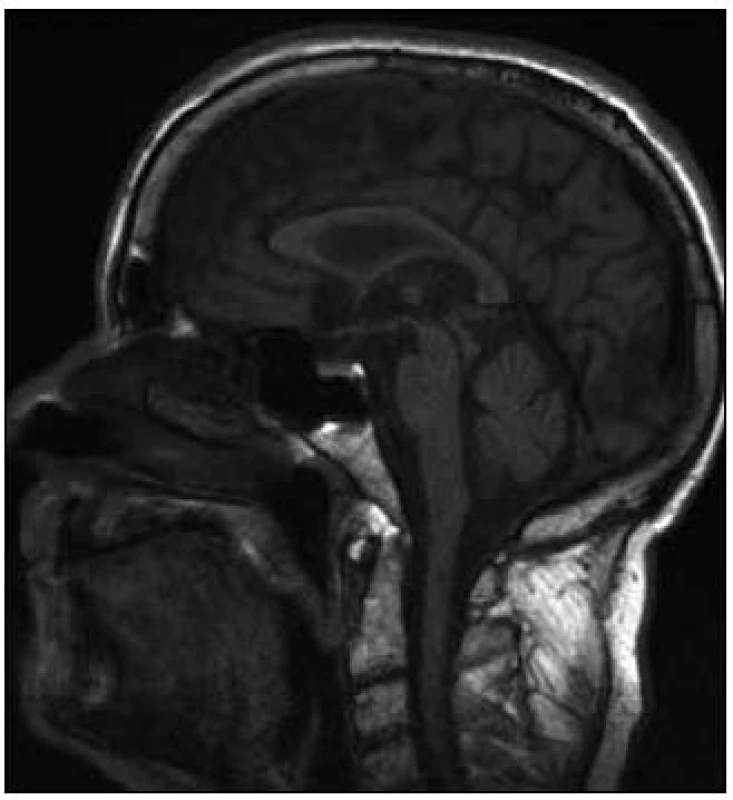 Vyšetření mozku magnetickou rezonancí, T1 vážený obraz, sagitální řez.
Je dobře patrno oploštění dorza mezencefala a napřímení kurvatury mozkového kmene, dohromady vytvářející tzv. hummingbird sign nebo standing penguin silhouette.