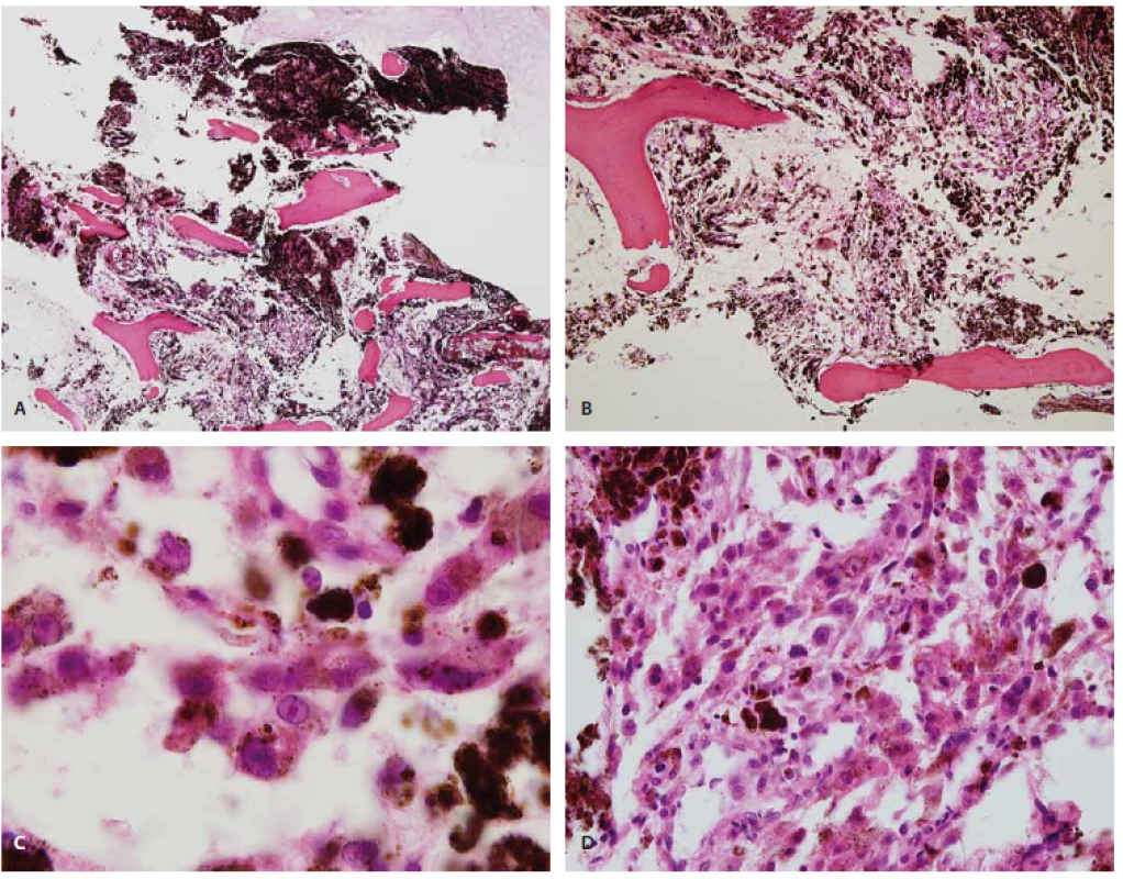 Histologically, the ovoid shaped tumour cells have replaced the marrow cavity of the vertebral body (hematoxylin and eosin, × 100) (A). Small foci of tumour cells are found in abundant pigments (hematoxylin and eosin, × 200) (B). The tumour cells have a prominent intranuclear pseudoinclusion with abundant melanin and hemosiderin (hematoxylin and eosin, × 1000) (C). Lung biopsy shows nests of ovoid shaped tumour cells and melanin, consistent with metastatic melanotic schwannoma (hematoxylin and eosin, × 400) (D).