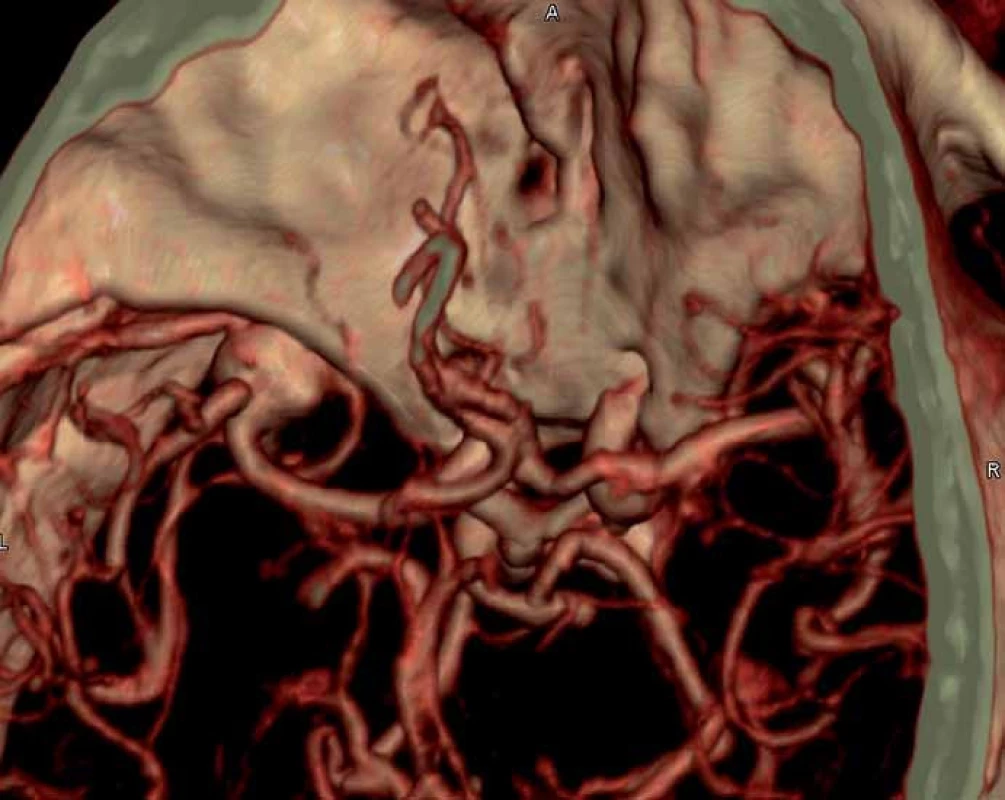 CT angiografie – prokázala výduť na střední mozkové tepně vlevo velikosti 13 × 11 × 10 mm.