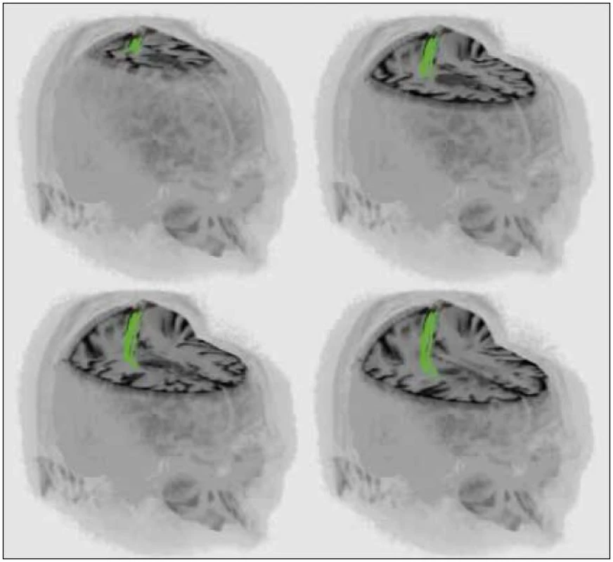 3D rekonstrukce MR vyšetření jednoho z pacientů (muž, 34 let, histologicky anaplastický astrocytom) s intraaxiálním tumorem v blízkosti kortikospinální dráhy.