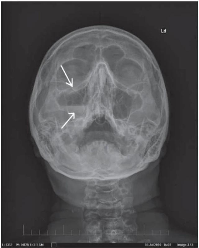 RTG lebky: 47-ročný pacient po úraze páčidlom do tváre pod pravé oko – spodná projekcia.