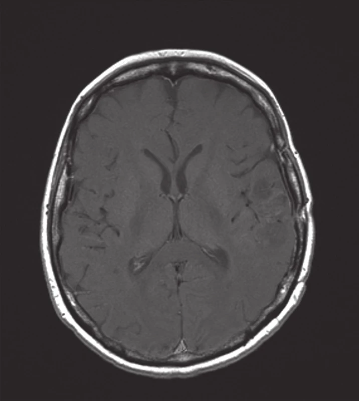 Remise nálezu po proběhlé PCV chemoterapii (MRI: T1 vážený obraz po podání gadolinia).