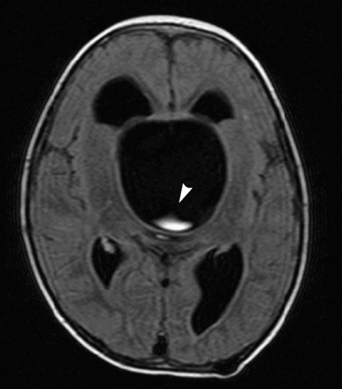 Předoperační MRI u pacienta č. 4. Na FLAIR sekvencích je možné pozorovat proudění moku směřující od bazilární arterie směrem vzhůru do supraselární cysty (šipka).