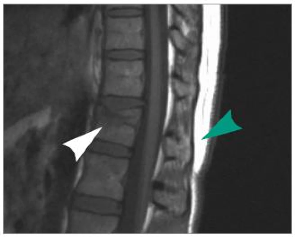 MRI v T1-váženém zobrazení v sagitální rovině ve střední čáře. Zelená šipka zobrazuje intaktní supraspinózní a interspinózní vaz Th 11/Th12. Bílá šipka zobrazuje impakci a defekt horní krycí desky Th12.