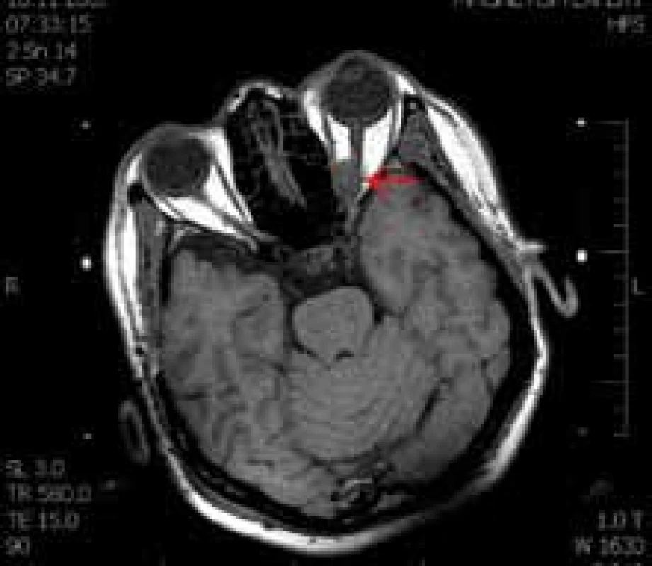 MR levé orbity, T1 vážený obraz, axiální řezy u 42leté pacientky s meningeomem apexu orbity, dva roky po resekci. Pro progresi rezidua indikována léčba gama nožem. Červená šipka indikuje patologii.