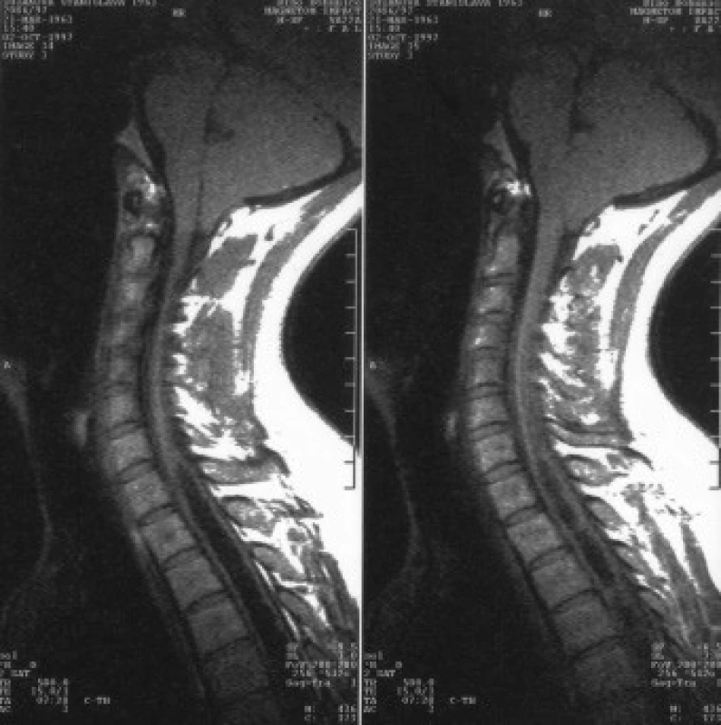MRI vyšetření 34leté ženy s Chiariho malformací typu I A.