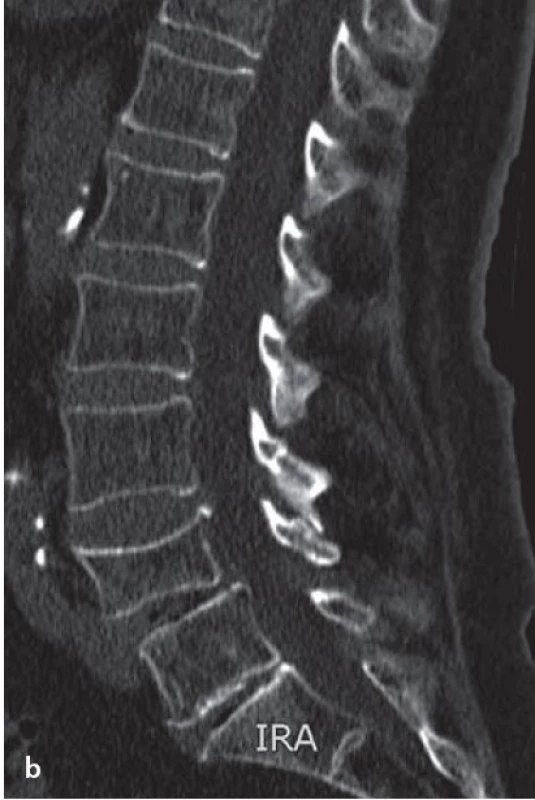CT zobrazení bederní páteře.