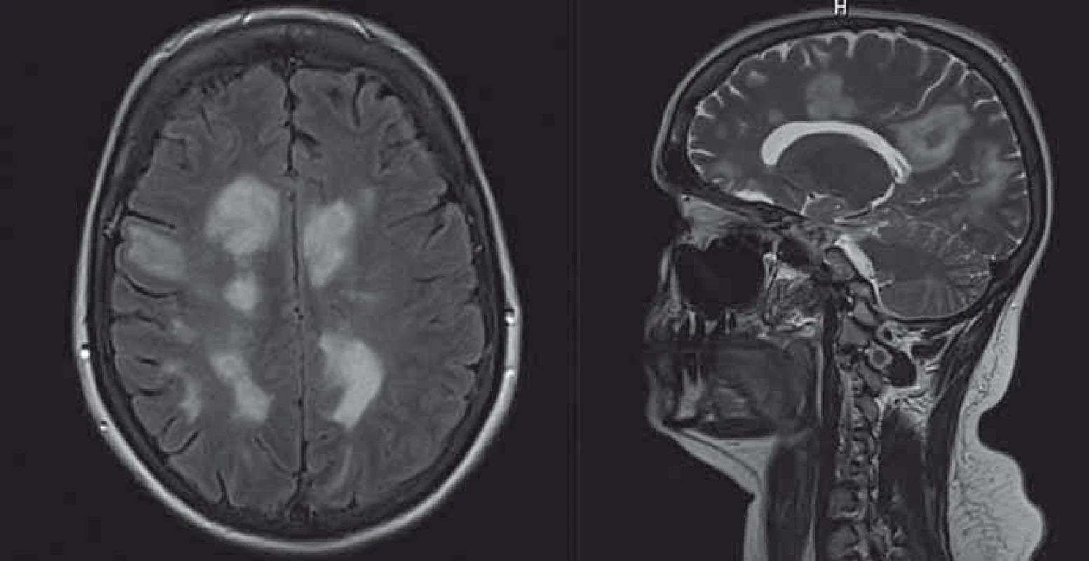 Iniciální MR mozku (koronární a sagitální řezy) u pacientky diskutované v kazuistice 2 
s pozitivitou anti-NMDAR klinicky manifestující se non-konvulzivním epileptickým statem.
Fig. 1. Initial brain MRI (coronary and sagittal sections) in a patient discussed in Case 2 with anti-NMDAR positive clinical manifestations of non-convulsive status epilepticus.