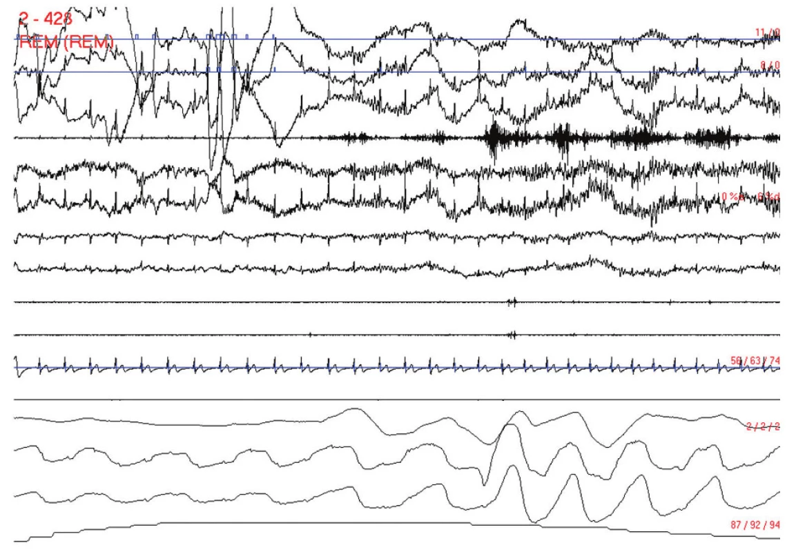 Probuzení na konci obstrukční apnoické pauzy. Polysomnografický záznam trvající 30 s. Svody: 1–3: oční pohyby, 4: povrchové EMG svalů brady, 5–8: EEG C2–C3, C1–C4, O1–A2 a O2–A1, 9 a 10: povrchové EMG svalů tibiales anteriores dextri et sinistri, 11: EKG, 12: proud vzduchu před nosem a ústy, 13 a 14: dýchací pohyby hrudníku a břicha, 15: saturace periferní krve kyslíkem v procentech.
