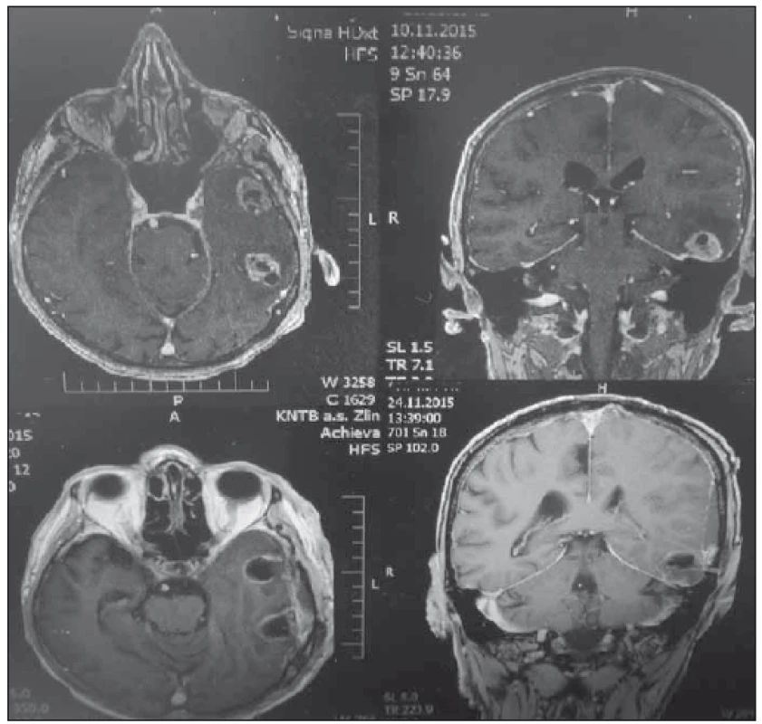 Před- a pooperační MR mozku jednoho z pacientů s multiformním glioblastomem.
Fig. 2. Pre- and post-operative MRI brain of one of the patients with glioblastoma multiforme.