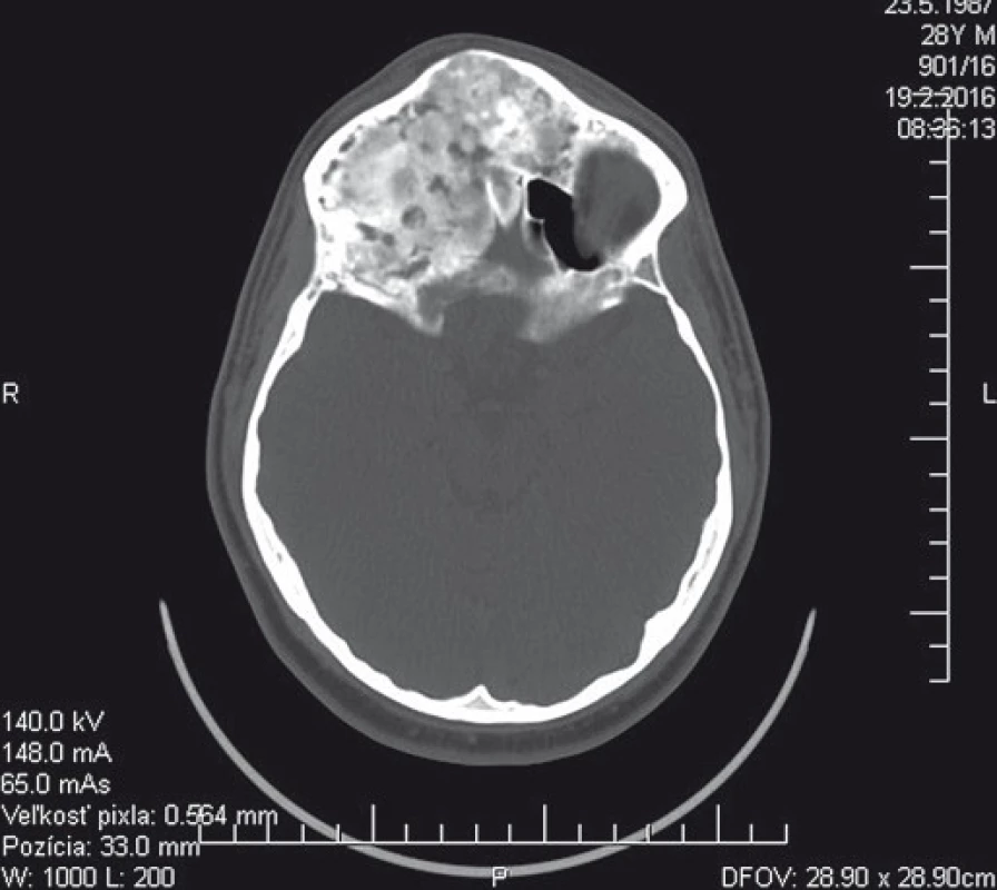 Predoperačné CT vyšetrenie (axiálny rez) s nálezom kostného tumoru v oblasti prednej jamy lebkovej a prínosových dutín.
Fig. 1. Preoperative CT scan (axial view) showing bone tumor within anterior cranial fossa and paranasal sinuses.
