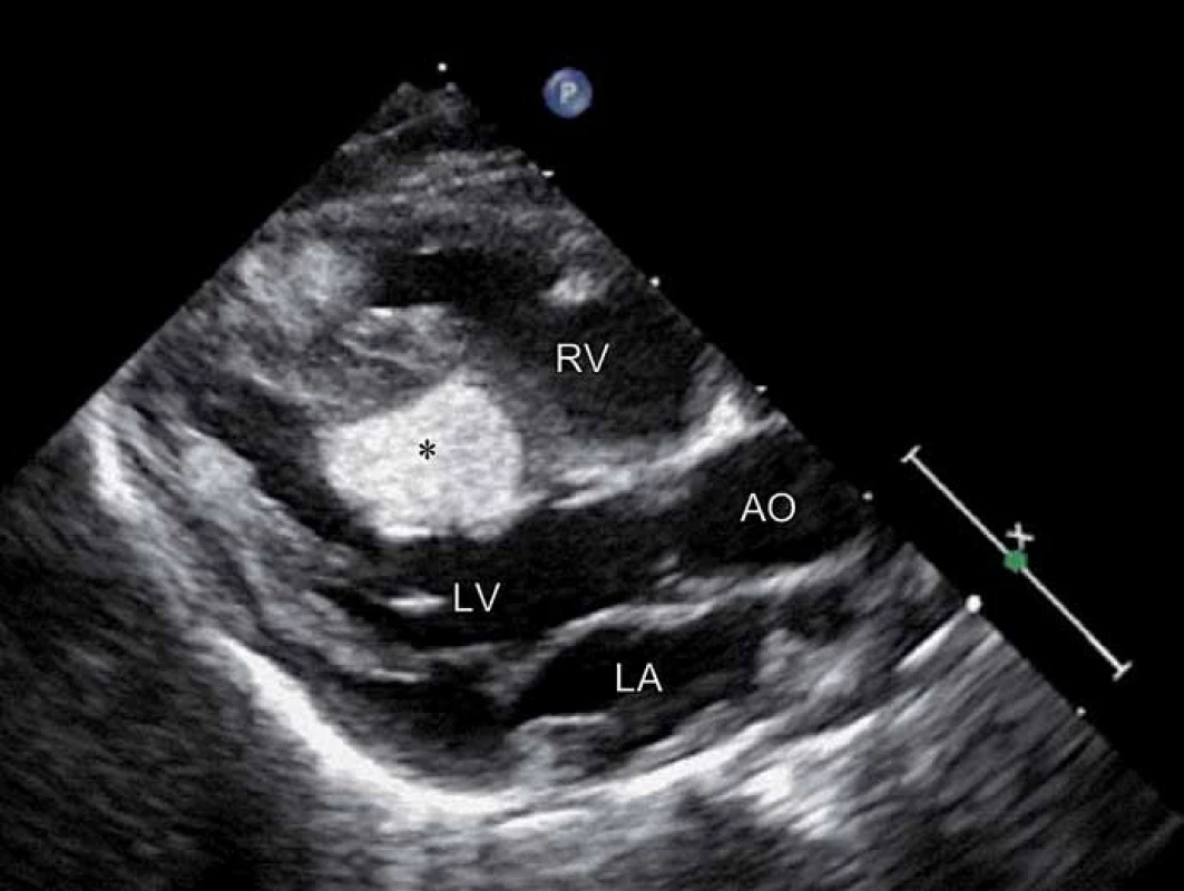 Echokardiografické vyšetření u pacienta 2.
V parasternální dlouhé ose zobrazen velký rhabdomyom (*) vycházející ze septa levé komory (LV). Další malé mnohočetné hyperechogenní nádory jsou patrné ve stěně a septu pravé komory (RV) a úponu mitrální chlopně na volnou stěnu levé komory. Levá síň (LA), aorta (AO).