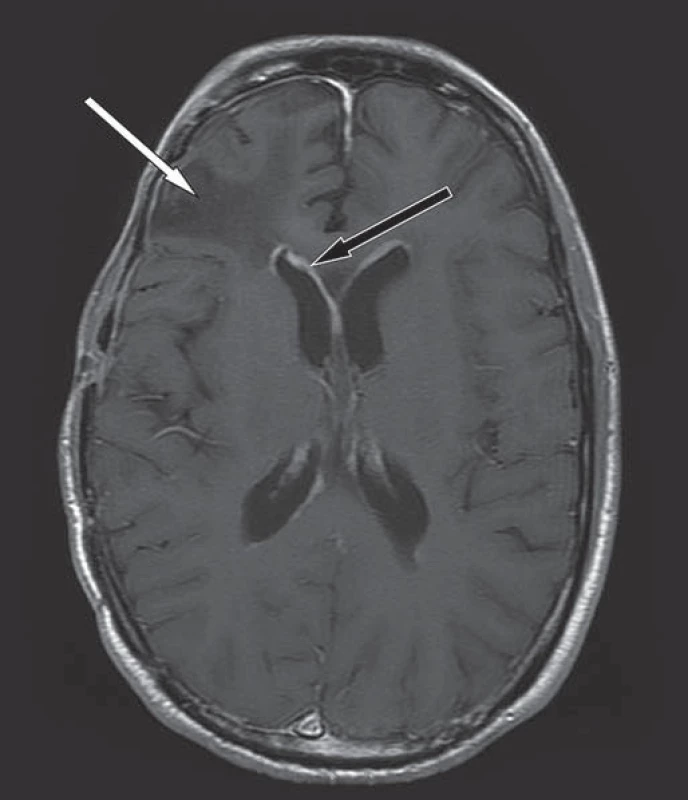 Kontrolní MR mozku v T1W obraze, axiální rovina, po podání k. l.

