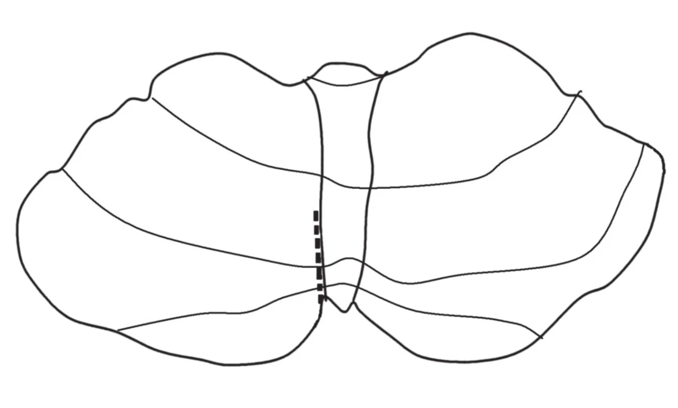 Zjednodušené schéma telovelárního přístupu cerebelomedulární fisurou. Nedochází k rozetnutí vermis a eliminuje se riziko vzniku cerebelárního mutizmu.