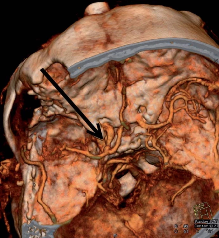 CT angiografie zobrazuje průchodnou, mírně zúženou krkavici po sutuře defektu a chudší náplň periferie střední mozkové tepny.