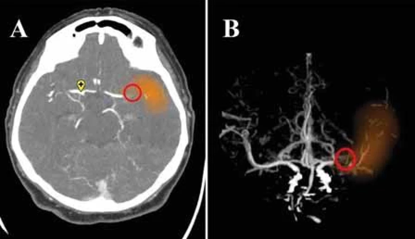 (A) Miesto uzáveru M1 segmentu arteria cerebri media vľavo detegované umelou inteligenciou z CTA, označené v červenom kruhu. (B) Identický pacient, označenie miesta uzáveru M1 segmentu arteria cerebri media vľavo softvérom umelej inteligencie e-CTA Brainomix® z CTA aj na koronálnych MIP rekonštrukciách, označené v červenom kruhu.