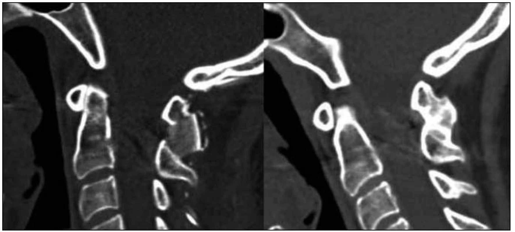 Průběh kostního hojení zobrazený CT sagitální rekonstrukcí – stav po operaci a dokončená fúze oblouků C1/C2 rok po výkonu.