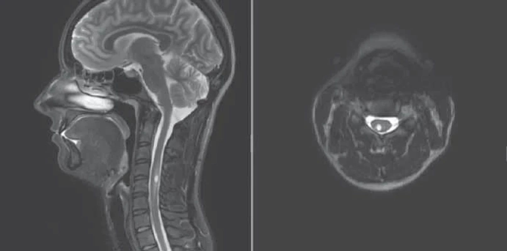 Postkontrastní zobrazení MR mozku a krční míchy při poslední kontrole pacientky. Na sagitálním (A) i axiálním (B) řezu je patrný hemangioblastom krční míchy v oblasti C3/4.