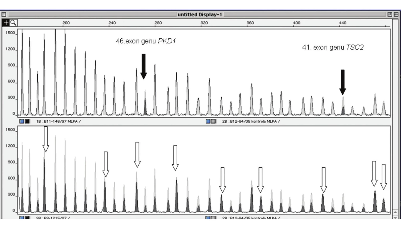 Detekce rozsáhlých delecí TSC2 genu metodou MLPA. Obrázek představuje výřez elektroforetogramu z kapilární elektroforézy. Černé peaky jsou PCR produkty DNA pacienta, šedé označují fyziologickou kontrolní DNA. V horní části: redukce signálu PCR produktu 46. exonu PKD1 a 41. exonu TSC2 (šipky) ve srovnání s fyziologickou kontrolou prokazuje distální deleci TSC2 genu. V dolní části: redukce signálu všech sledovaných exonů TSC2 a 46. exonu v genu PKD1 ve srovnání s fyziologickou kontrolou prokazuje kompletní deleci testovaného lokusu. Šipky označují vnitřní kontrolní produkty.