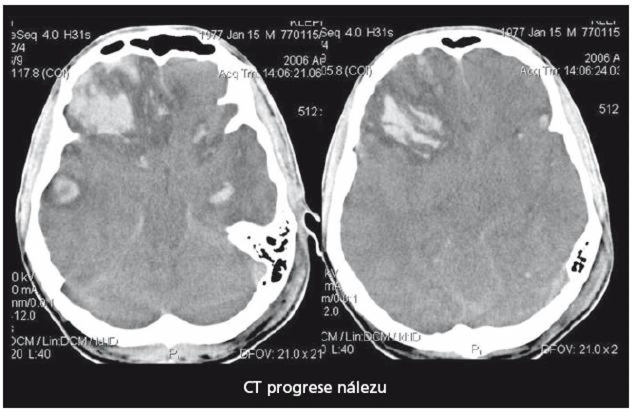 Kontrolní CT mozku u pacienta 1 při vzestupu ICP.
