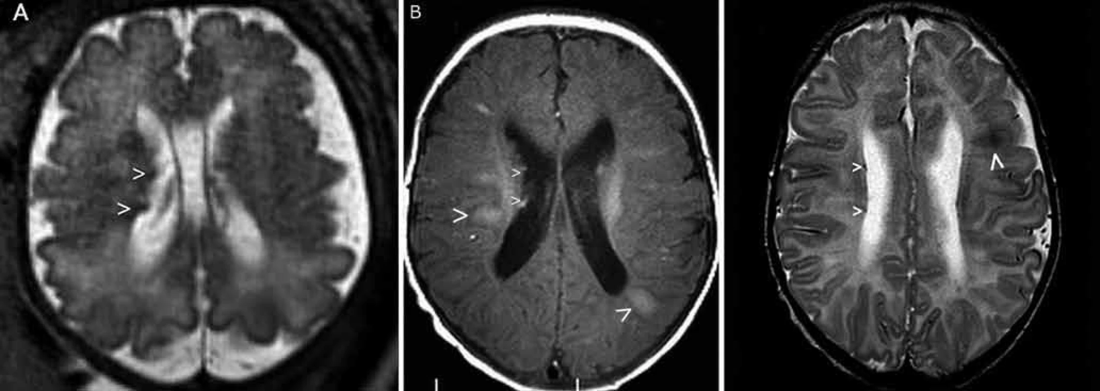 Prenatální (a) a postnatální (b, c) MR vyšetření u pacienta 2.
Obr. 3a) Prenatální MR vyšetření mozku, 34. gestační týden – dva subependymální noduly v pravé postranní komoře (šipky), nezralá myelinizace.
Obr. 3b) Postnatální MR vyšetření mozku, 2. měsíc života – sekvence flair v axiální rovině – mnohočetná hyperintenzní ložiska charakteru tuberů s migračními liniemi (velké šipky) a subependymální noduly (malé šipky).
Obr. 3c) Sekvence T2 v axiální rovině – vícečetné subependymální noduly jsou drobné, hyposignální (malé šipky). Tuber frontálně vlevo (velká šipka).