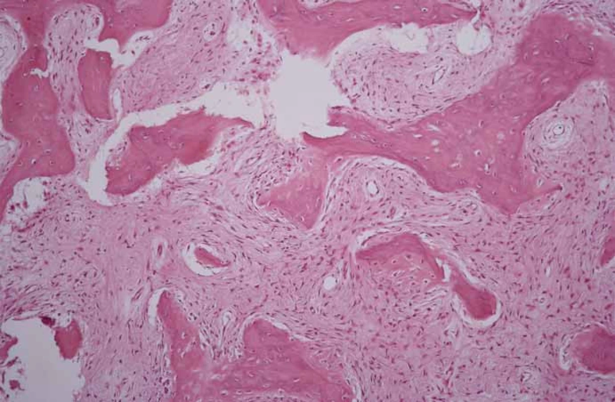 Histologický obraz fibróznej dysplázie.
Fig. 8. Histological picture of fibrous dysplasia.