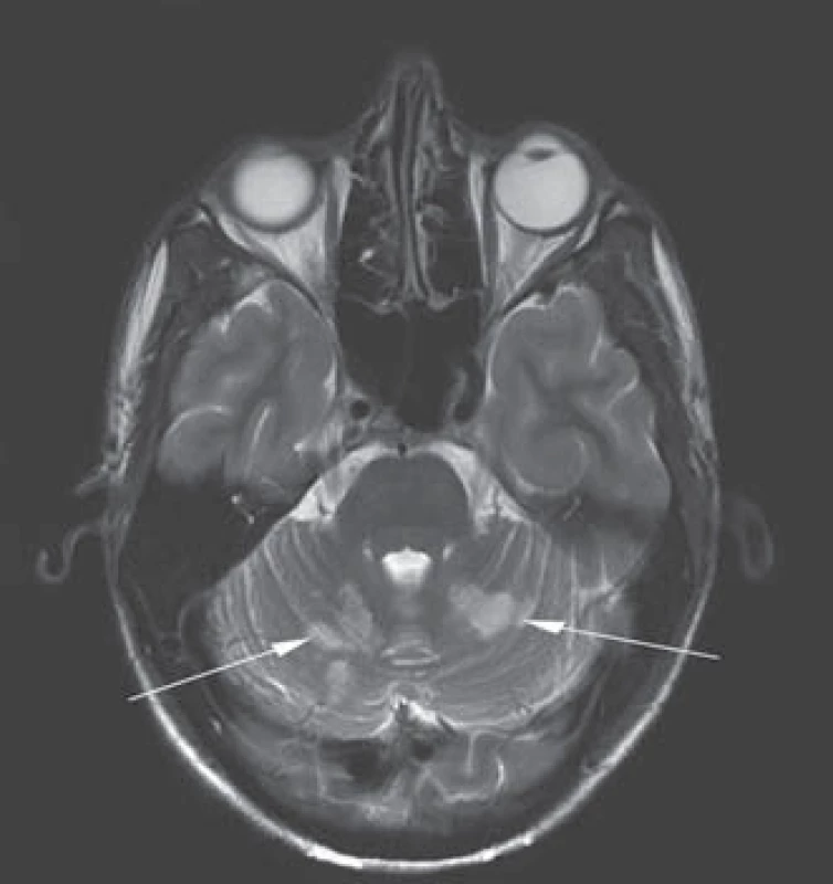 Mnohočetná ischemická ložiska v mozečkových hemisférách na MR v T2 vážených obrazech (šipky).