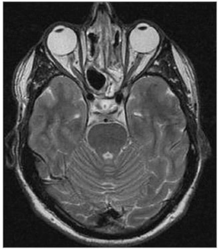 Pooperační MRI – paranazální dutiny volné, bez známek zastření, odeznívající zánětlivé změny v průběhu optického nervu.