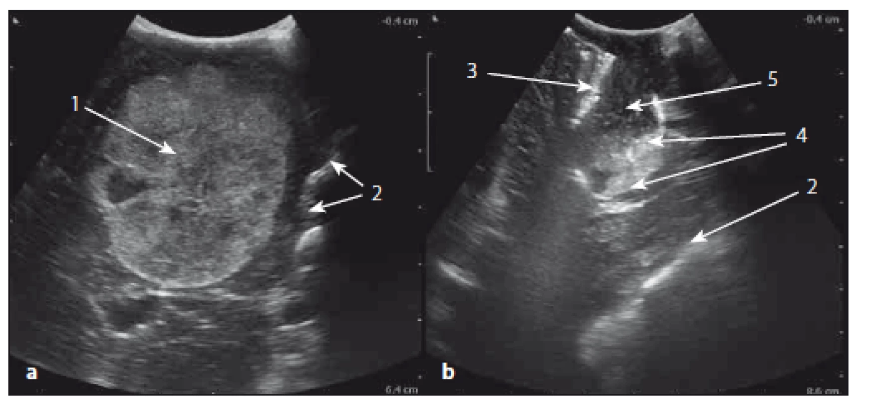 Sonografický obraz metastázy mozečku před a po resekci.
Fig. 4. The ultrasound image of cerebellar metastasis before and after resection.