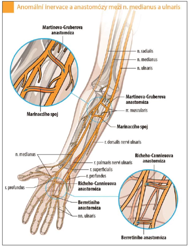 Anastomózy mezi n. ulnaris a n. medianus.
Fig. 5. Anastomoses between the ulnar nerve and the median nerve.