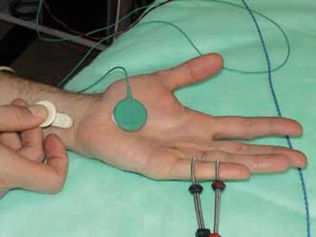 Metodika vyšetření senzitivních vláken n. ulnaris – vzdálenost katody stimulační elektrody na zápěstí a registrační prstýnkové elektrody (proximální) na malíku je 14 cm.
Fig. 12. The methods used for the ulnar nerve sensory fibers examination – the distance between the cathode of the stimulation electrode at the wrist and the registration ring electrode (proximal) on the little finger is 14 cm.