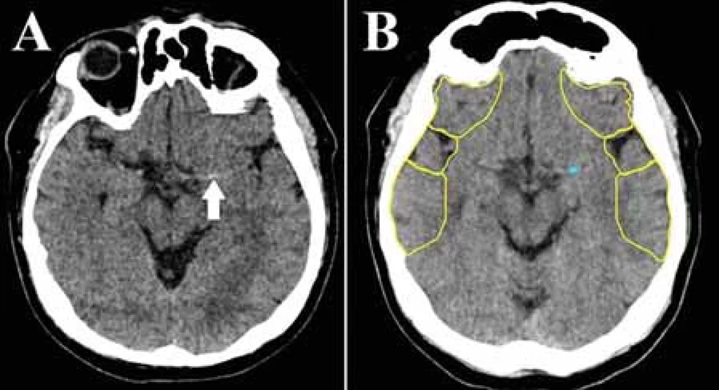 (A) Natívne vyšetrenie CT mozgu – príznak hyperdenznej cievy pri uzávere M1 segmentu arteria cerebral media vľavo (šípka). (B) Identický pacient, detekcia uzáveru M1 segmentu arteria cerebri media vľavo z natívneho vyšetrenia CT softvérom umelej inteligencie e-ASPECTS Brainomix® (označené modrou).