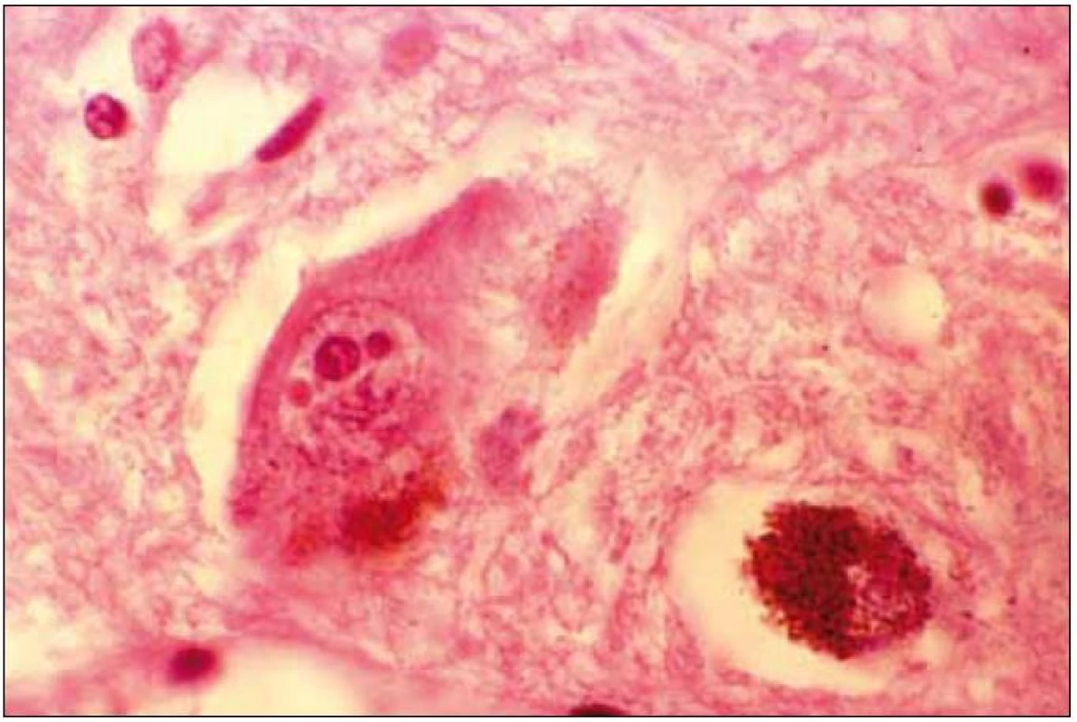 Velký depigmentovaný neuron se dvěma „Marinesco bodies“.
Barvení hematoxilin eozin.