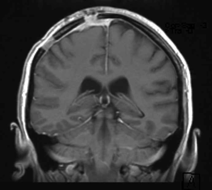 Kontrolní magnetická rezonance provedená šest měsíců po operaci nevykazovala známky recidivy tumoru.
Ztluštělé enhancující pleny mozkové byly hodnoceny jako pooperační změny.