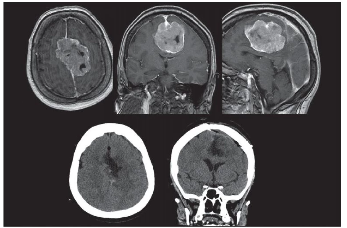 Meningeom falxu. Předoperační transverzální MR T1 s kontrastní látkou. Pooperační CT snímky. Resekce byla radikální včetně resekce falxu (origa).