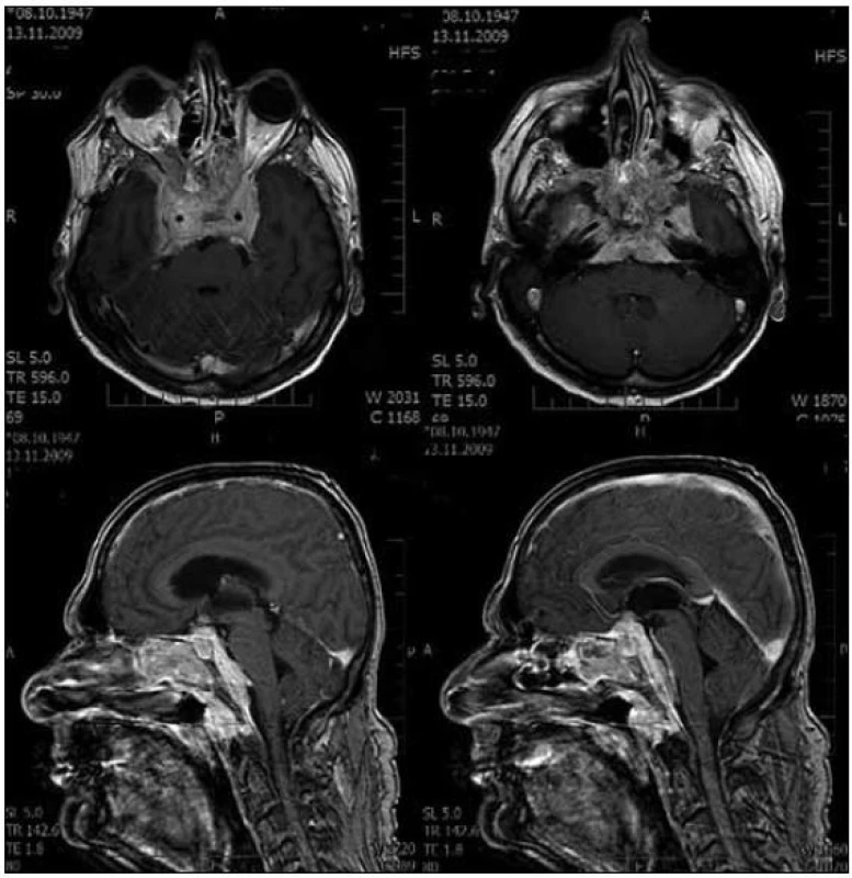 Kontrolní magnetická rezonance mozku, necelý rok po prvním vyšetření. Patrný nárůst objemu tumorózních hmot, nově prorůstání do sfenoidálních a etmoidálních dutin.
