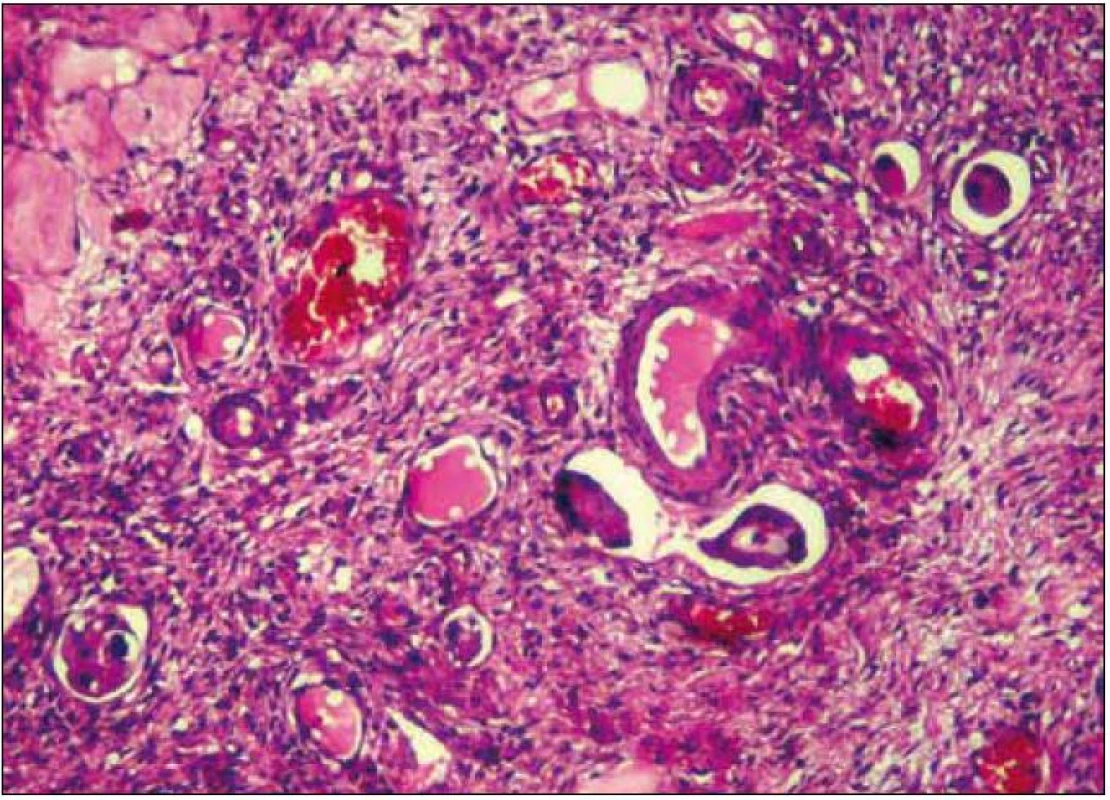 Histologický nález zjištěného adenokarcinomu – angioinvaze maligních buněk v ovariu (s poděkováním prim. MUDr. Pavlu Holanovi, Nemocnice Písek, a.s.).
