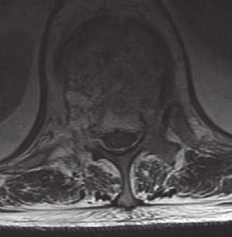 MR T2W obraz AHO Th12 s postižením pravého pediklu a laminy, s kompresí míšní při prorůstání tumoru do páteřního kanálu.