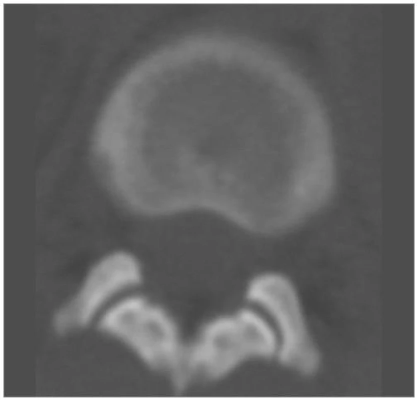 CT vyšetření obratle L1 v axiální rovině, na úrovni meziobratlových kloubů Th12/L1 neprokazuje subluxační postavení nebo frakturu kloubů.