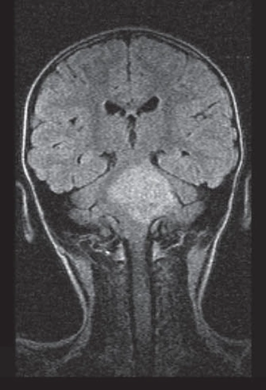 Pacient 3. Gliom mozkového kmene.