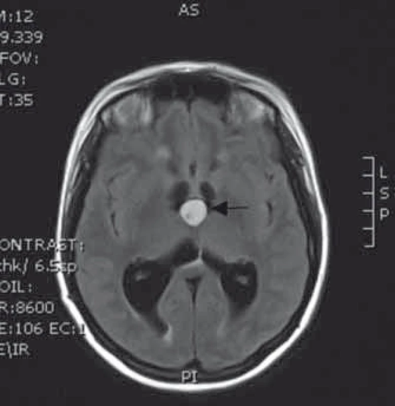 MR vyšetření koloidní cysty (šipka) bez hydrocefalu.
Fig. 5. MRI of the colloid cyst (arrow) without hydrocephalus.