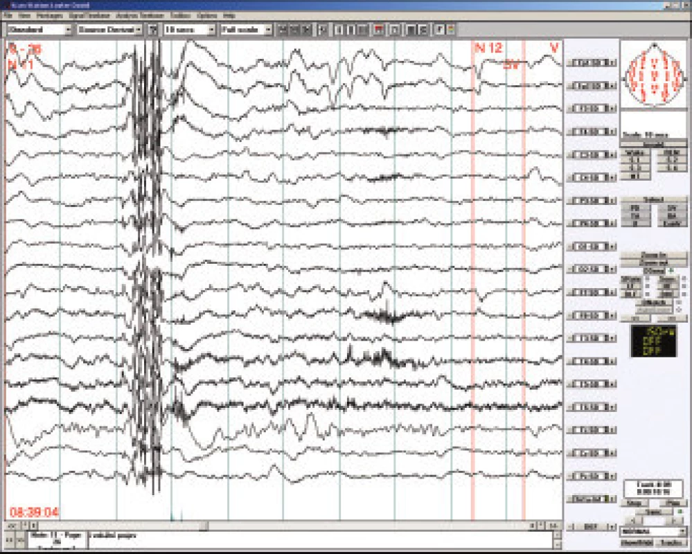Bdělé EEG u 16letého chlapce s juvenilní myoklonickou epilepsií. Polyspike-wave komplex na normálním pozadí EEG záznamu.