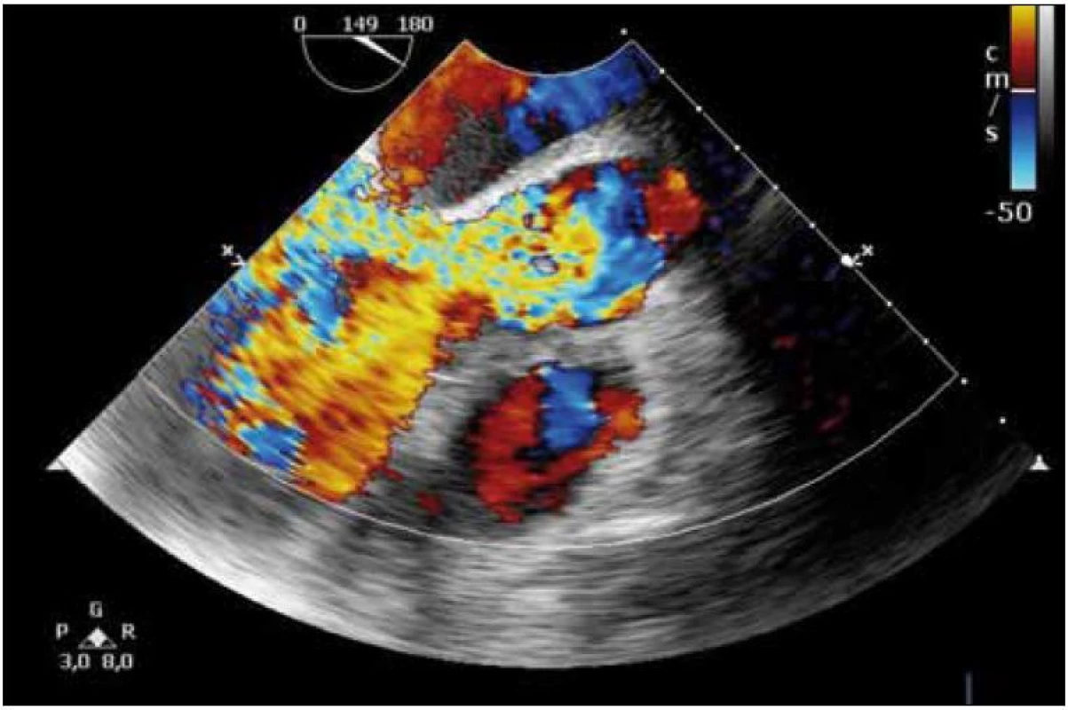 Transezofageální echokardiografické vyšetření, masivní aortální regurgitace v barevném dopplerovském mapování.