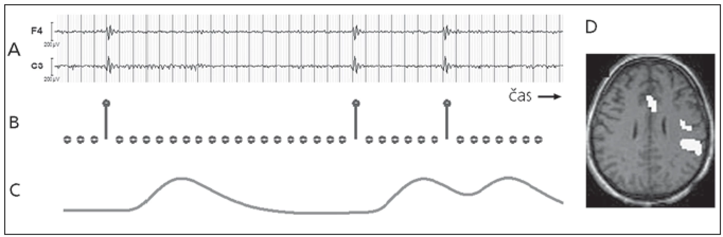 Zpracování fMR dat pomocí výbojů nalezených v interiktálním EEG záznamu.
a) interiktální EEG s výboji, b) stimulační funkce vytvořená na základě výbojů, c) GLM regresor vytvořený jako konvoluce stimulační funkce a HRF, d) výsledná statistická mapa znázorňující místa hemodynamických změn souvisejících s výboji (signifikantní efekt regresoru ve fMR datech).
