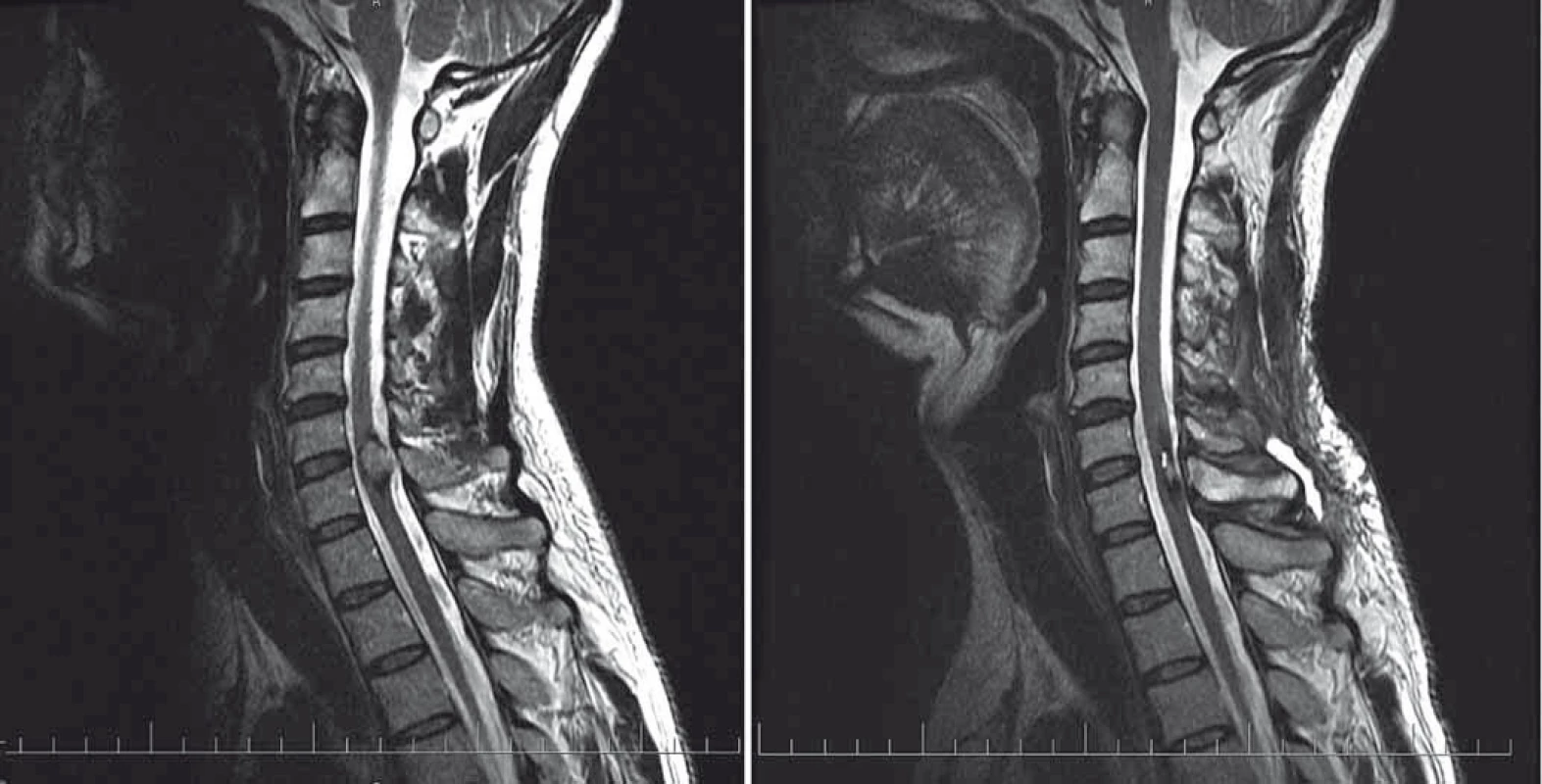 Pacient s intramedulárním kavernomem C6/7 před resekcí (vlevo) a po resekci (vpravo).
Fig.1. Patient harbouring intramedullary cavernoma at C6/7 level. Pre-op (left) and post-op (right) MRI scans.