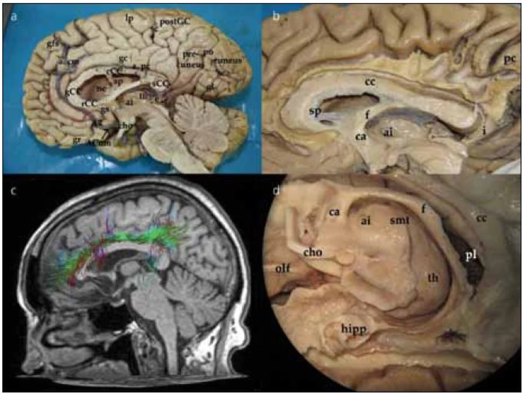 Mediální aspekt mozkové hemisféry, fasciculuscinguli, struktury limbického systému, thalamus.
Obr. 1a) Pohled na mediální stranu hemisféry z interhemisferického řezu.
ACom – přední komunikující arterie; A2 – A2 úsek přední mozkové arterie; a. cm – arterie calloso marginalis; a. pc – arteria pericallosa; gs – gyrus subcallosus; rCC – rostrum corporis callosi; gCC – genu corporis callosi; cCC – corpus corporis callosi; th – thalamus; e – epiphysis; ai – adhesio interthalamica; cho – chiasma opticum; gfs – gyrus frontalis superior; lp – lobulus paracentralis; sc – sulcus centralis; postGC – gyrus postcentralis; gl – gyrus lingualis; sca – sulcus calcarinus
Obr. 1b) Vypreparovaná vlákna gyrus cinguli. Je patrné rozšíření gyrus cinguli zvláště po připojení vláken z precuneu.
cc – corpus callosum; sp – septum; f – fornix; ai – adhesio intherthalamica; ca – commissura
anterior; pc – precuneus
Obr. 1c) Traktografie vláken gyrus cinguli.
Obr. 1d) Hluboké středočárové struktury limbického systému a bazálních ganglií z mediálního pohledu.
olf – tractus olfactorius; cho – chiasma opticum; ca – commissura anterior; ai – adhesio intherthalamica; smt – stria medullaris thalami; th – thalamus; f – fornix; pl – plexus choroideus; cc – corpus callosum; hipp – hippocampus