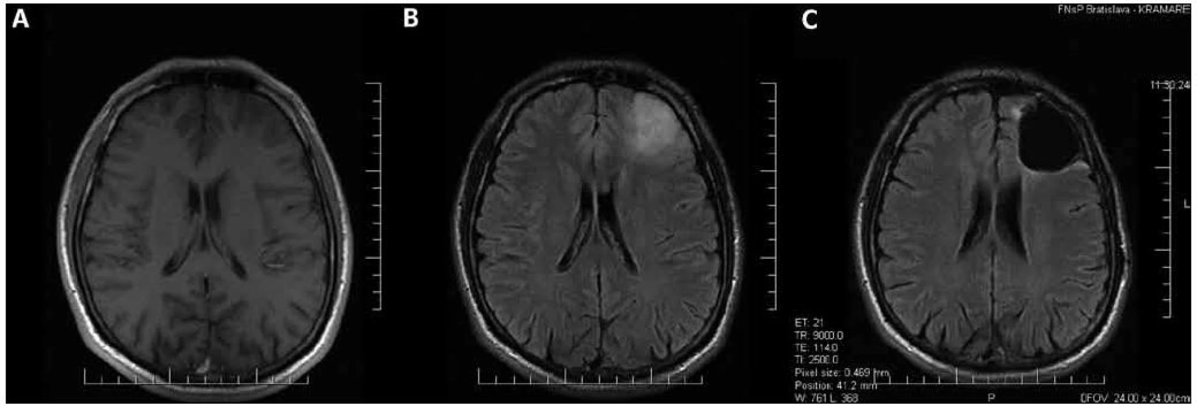 Oligodendroglióm druhého stupňa malignity v ľavom čelovom laloku.
Predoperačné MR v T1 (a) a FLAIR (b) sekvencii; nádorom infiltrovaný parenchým mozgu sa v T1 sekvencii takmer nezobrazil. c) Stav po radikálnej resekcii nádoru zobrazený vo FLAIR sekvencii; tenký hyperintenzívny lem na okraji resekčnej dutiny je pooperačná glióza, nachádza sa mimo miest, kde bolo predoperačne lokalizované hyperintenzívne gliómové tkanivo.
